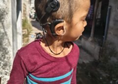 RBSK યોજના હેઠળ વિનામૂલ્યે થયું ₹૭ લાખનું કોક્લીયર ઇમ્પ્લાંટ ઓપરેશન